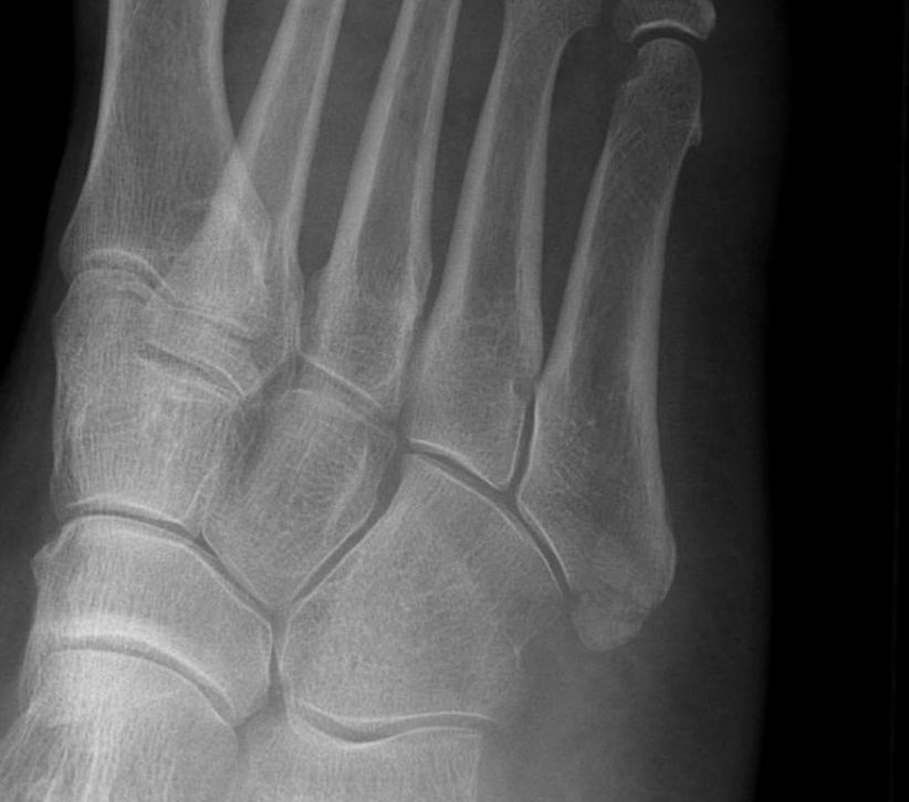 Base of fifth MT Fracture